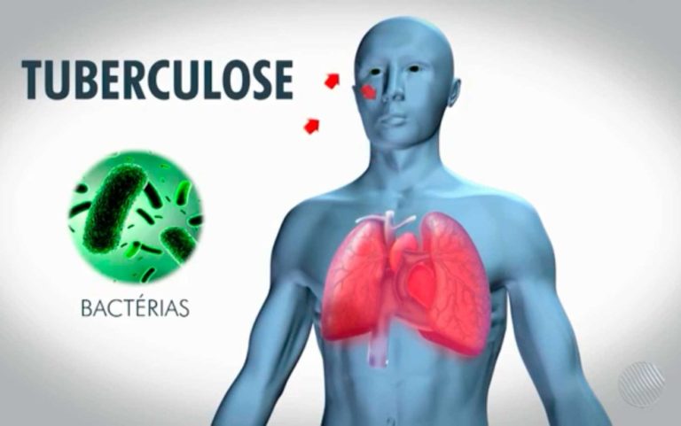 Ministério da Saúde e Cidadania se unem no combate à tuberculose