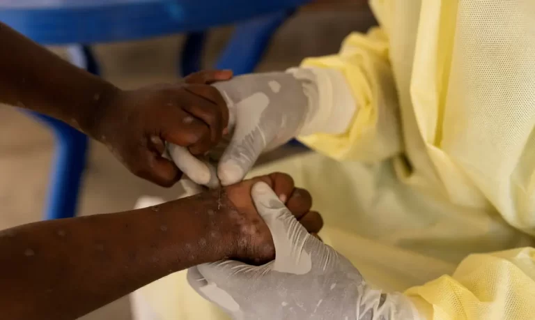 Tailândia confirma primeiro caso de nova variante da mpox